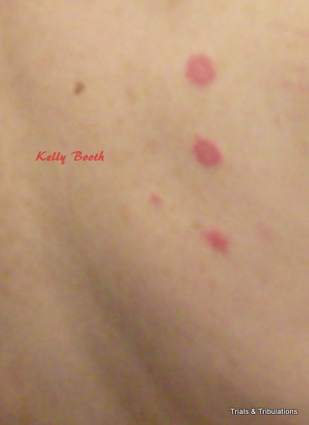bed bugs got bed bugs http bedbugger com 2010 08 21 new photo of bed ...