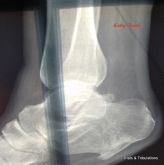 Kelly Booth foot x-ray